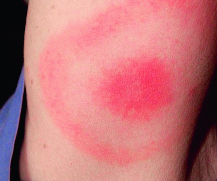 borrelioos2 (1).jpg